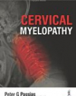 Cervical Myelopathy