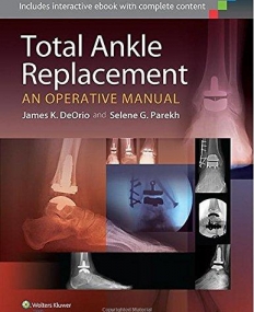 Total Ankle Replacement:  An Operative Manual