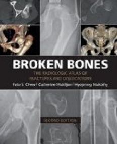 Broken Bones: The Radiologic Atlas of Fractures and Dislocations 