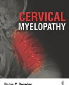 Cervical Myelopathy