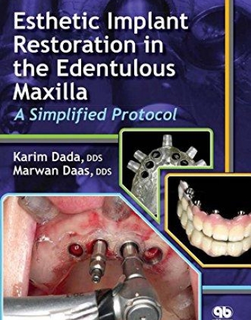 Esthetic Implant Restoration in the Edentulous Maxilla: A Simplified Protocol